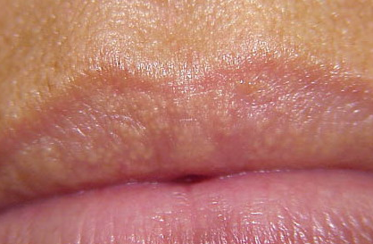 small red bumps on nose #10