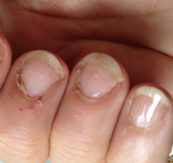 Finger Skin Peeling - Doctor answers on HealthTap