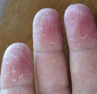 Flaking, peeling skin on fingers - Dermatology - MedHelp