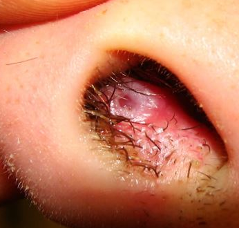 Stages of Herpes | MD-Health.com