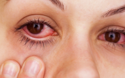 How to Make Your Eyes Red Fast: Bloodshot, to Look High ...
