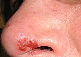 Painful Sores In Nose – Causes, Symptoms And Treatment For ...