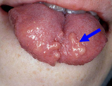 What causes painful little bumps on the tongue? What gets ...