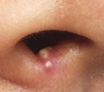 White Bump on Eyelid | Med-Health.net