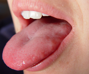 Sore Tongue: Check Your Symptoms and Signs - MedicineNet