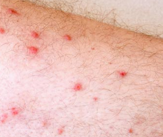 Rash On Upper Arms And Thighs - Doctor answers on HealthTap