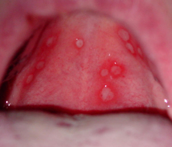 Rash On Roof Of Mouth 54