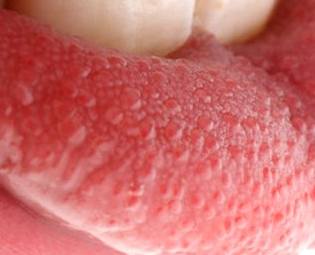 Painful white bumps on tongue - Ears, Nose, Mouth & Throat ...