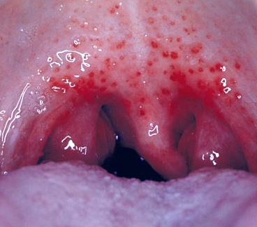 Red Dots Inside Mouth 14