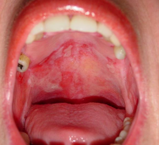 What are some remedies for a sore soft palate?