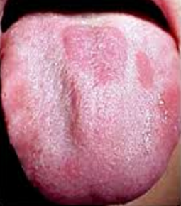 Red Spots On Tongue Small Dots Tip Back How To Get Rid Of