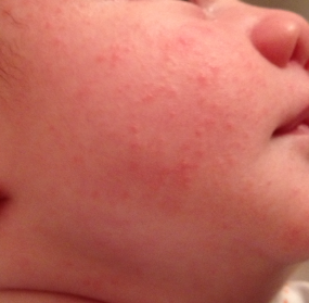 Pictures Of Babies Face Rash 87