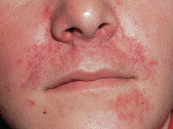 Red Facial Bumps 112