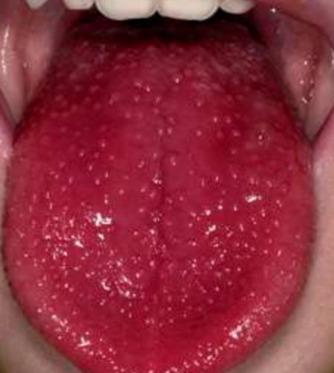 Pictures Of Spots On Tongue 8