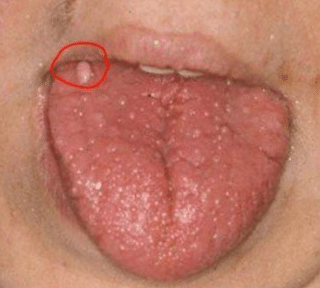 Swollen Taste Buds (Inflamed), On Back of Tongue, Sides, Causes, Std