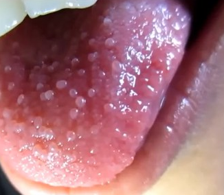 Red Bumps On Tongue Causing Pain | Home Remedies by ...