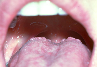 Bumps On Tongue Throat 56