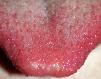 White Spots on Tongue, Bumps, Patches, Painful, Sore Throat, STD, on 