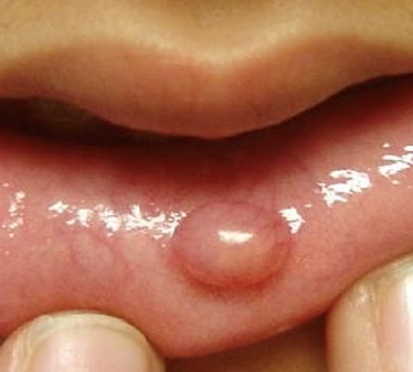 Cold Sores (Mouth Herpes)