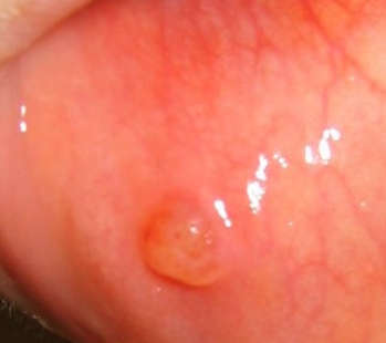 Red Bump On Roof Of Mouth 48