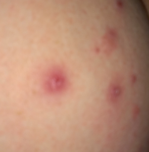 pimples on buttocks children