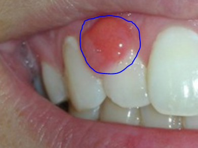 Lump On Gum In Mouth 45