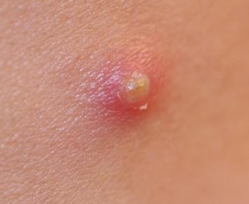 tiny red bumps on chest