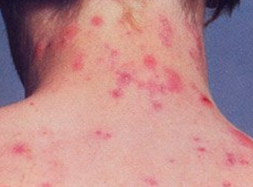 pimples on back of neck