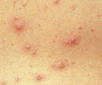 What is this itchy rash on my chest? | Zocdoc Answers