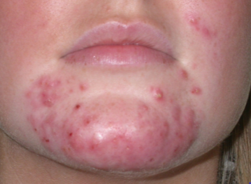Topical steroid cream for rash