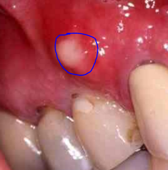 White Growth In Mouth 82