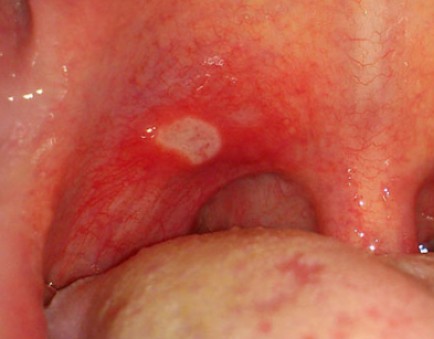 Small Hole In Roof Of Mouth 4