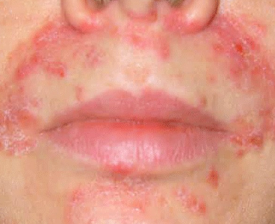 Red Dry Skin Around Mouth 7