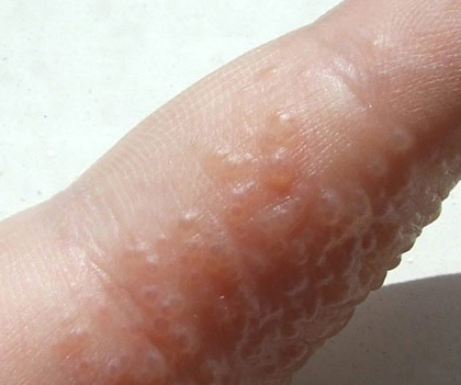 Painless bumps between toes - Dermatology - MedHelp
