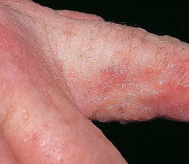 Tiny, itchy, skin coloured bumps on hands? | Yahoo Answers