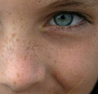 Facial Skin Spots 87