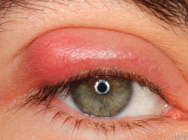 skinsight - Dermatitis, Contact