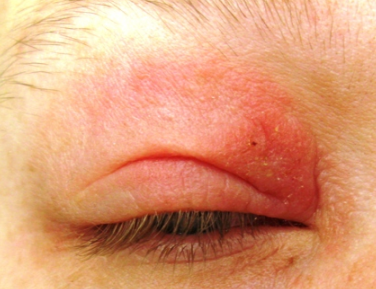 Dry Scaly Eyelids - LoveToKnow - Skin Health