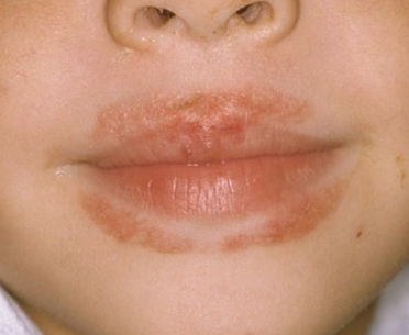 Red Dry Skin Around Mouth 27