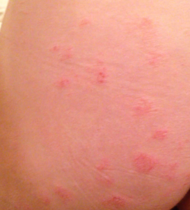 Itchy Rash on Butt Cheek - Dermatology - MedHelp