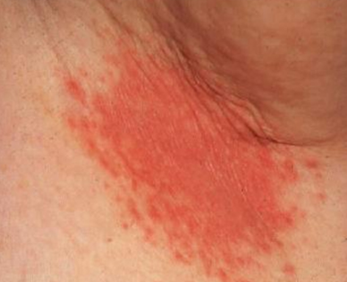 red rash under armpits