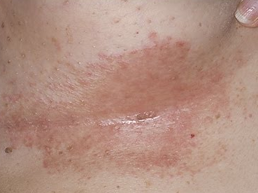Heat Rash: Pictures, Remedies, and More - Healthline