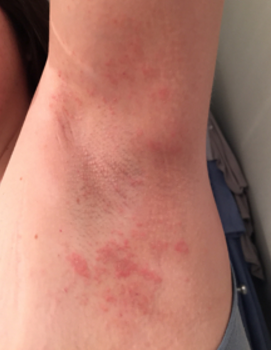 Painful Red Rash Under Armpit - Doctor answers on HealthTap