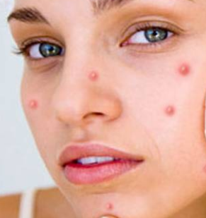 Pimple Face How to avoid pimples, marks, on face, oily face, after 