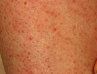 random rash on arm