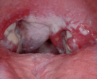 Sores on Tongue, Pictures, White, on Sides, Tip, Back, std ...