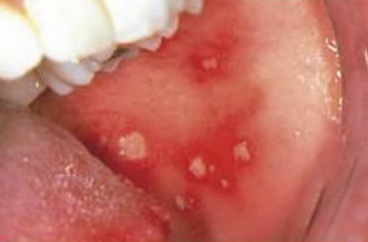 Can you get canker sores on vagina lips - Answers.com