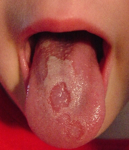 Geographic Tongue & White Tongue Causes & Treatment ...