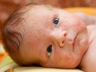 heat rash on newborns