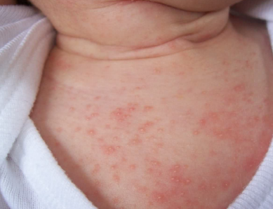 heat rash on babies face #9